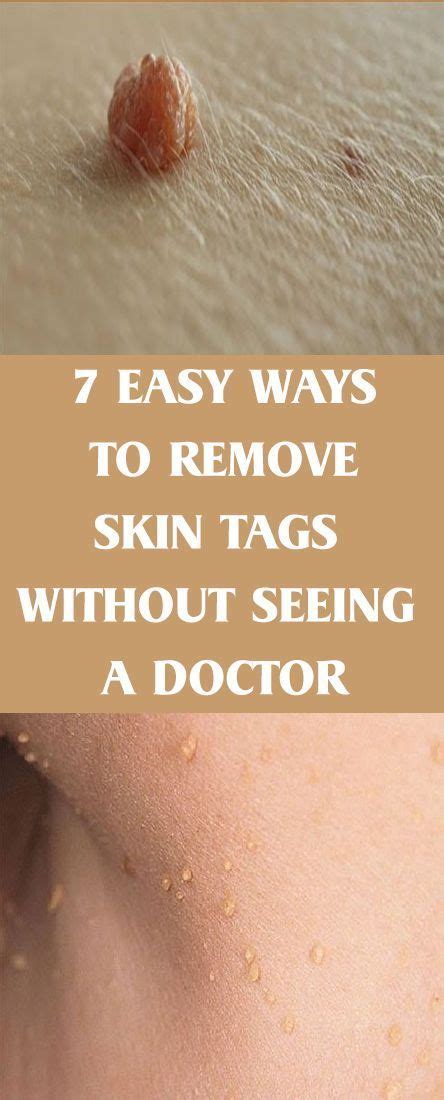 dior skin tag remover|skin tags and weight loss.